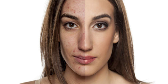 3 Vital Home Remedies To Treat Skin Blemishes