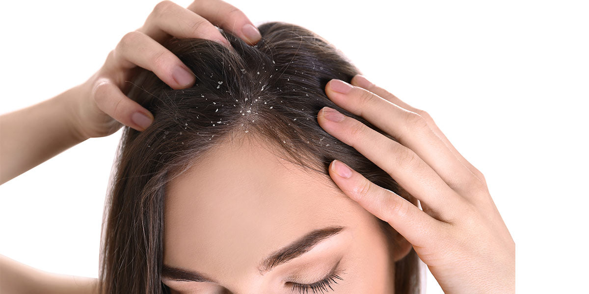 Oily Scalp Dandruff: Causes And DIY Treatments At Home – MyCocoSoul