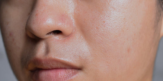 How To Heal Oily Skin Problems