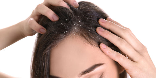 woman with dandruff in winter