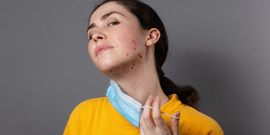 For A Good Riddance! Here’s All You Need to Know About Fungal Acne & Ways to Treat It