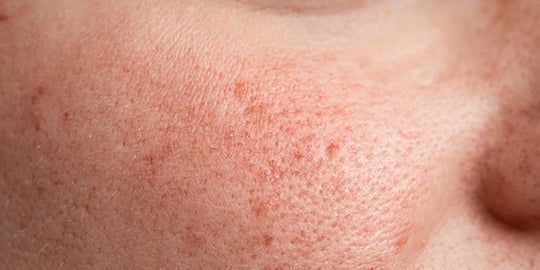 What Do Visible Pores Indicate? A Comprehensive Guide On Skin-Oriented Signs