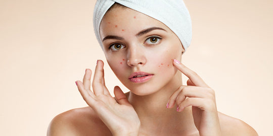 Stress Acne to Period Acne, 5 Types of Acne, Their Causes to Treatment