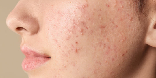 How to treat acne in the monsoon?