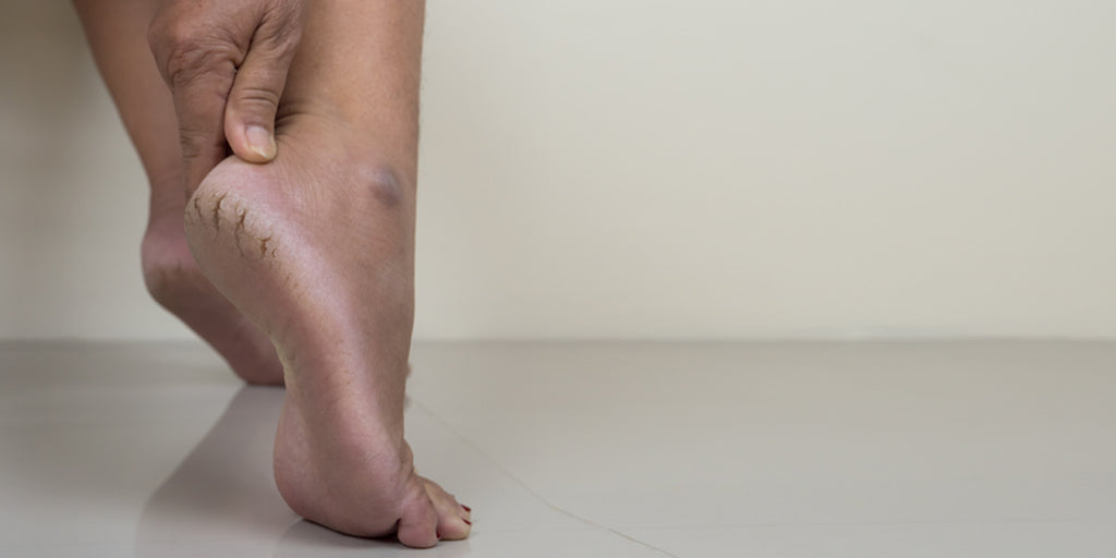 Help for Cracked Heels — Caring Podiatry
