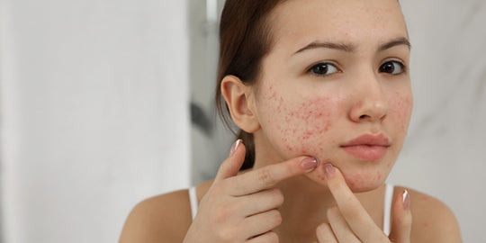 Ayurvedic Remedies To Cure Acne