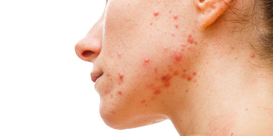 Struggling with Hormonal Acne? These Ayurvedic Remedies Can Come to Your Rescue