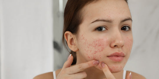Identifying acne vs pimples on face?
