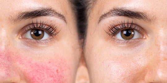 Identifying The Four Types Of Rosacea